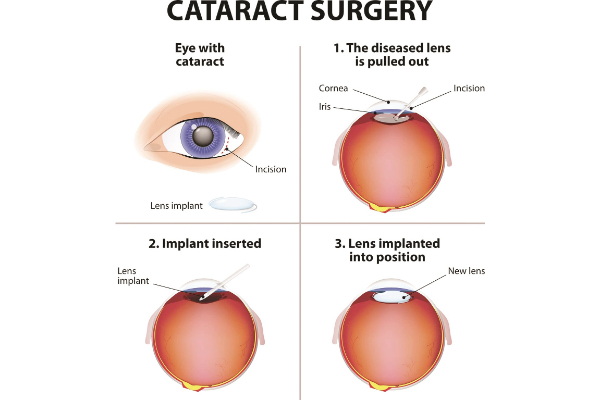 Free cataract surgery for eligible females 