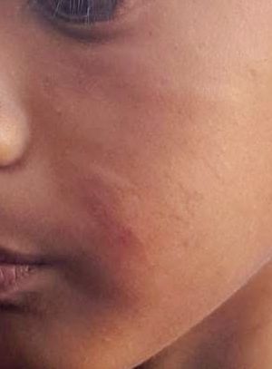 The boy’s cheek shows clear finger marks and swelling after the alleged incident.