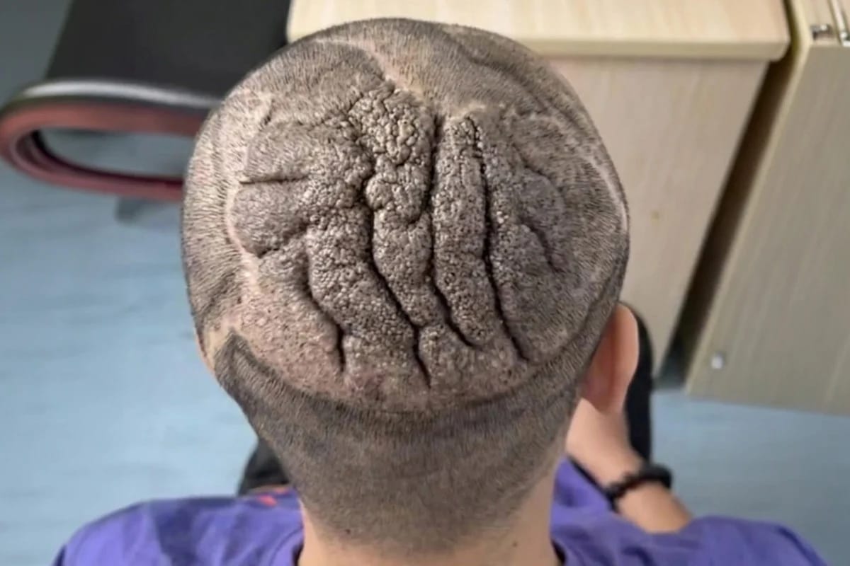 Rare scalp condition reversed after 11-month treatment